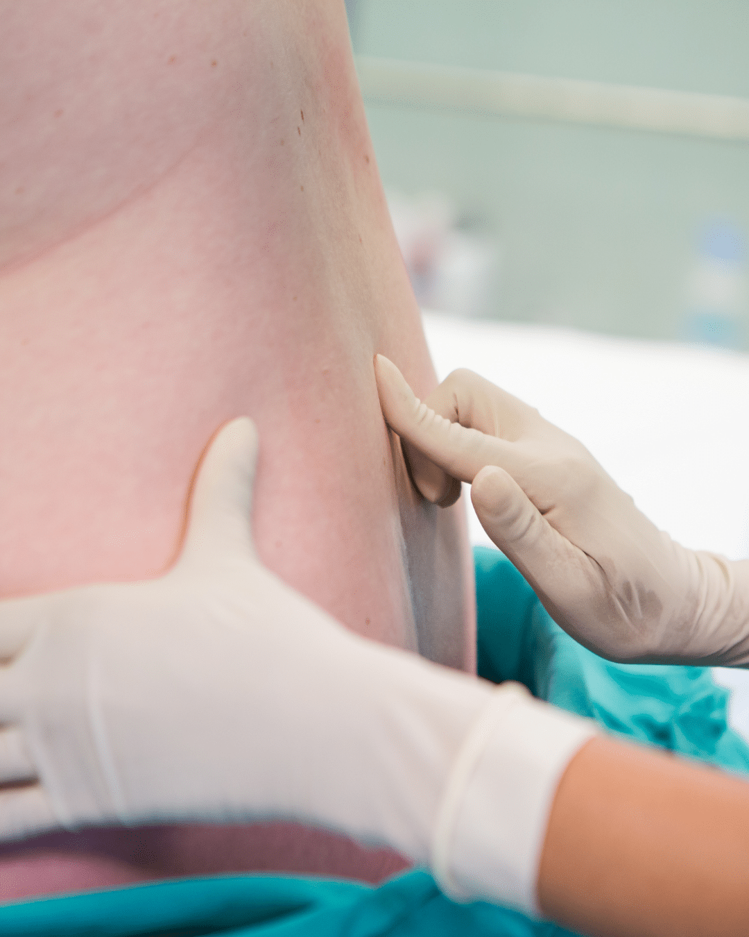 Epidurals for Labor: What to Know Before You Decide