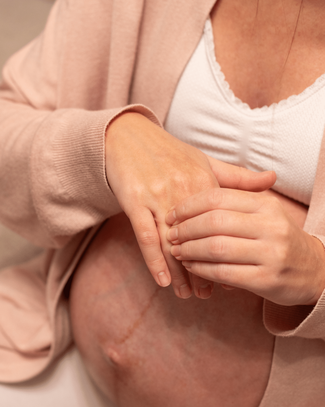 Swelling in Pregnancy